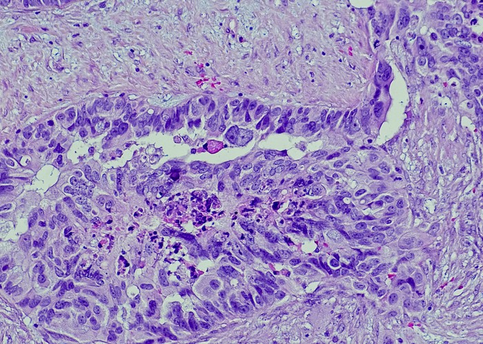 Serous carcinoma is the most common type of ovarian cancer, accounting for approximately 75% of epithelial ovarian cancers.